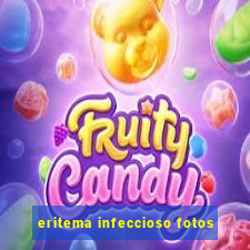 eritema infeccioso fotos